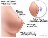 Photos of Symptoms Breast Tumor