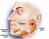 Images of Salivary Gland Cancer Symptoms