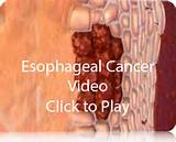Esophageal Carcinoma Images