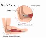 Chronic Elbow Inflammation Images