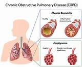 Chronic Obstructive Pulmonary Disease And Asthma Pictures