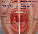 Images of Viral Infection Throat Symptoms