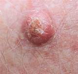Cancer Skin Symptoms Images