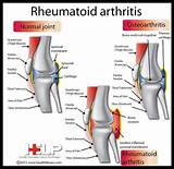 Rheumatoid Arthritis Autoimmune