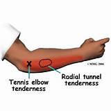 Pictures of Lateral Epicondylitis Radial Nerve