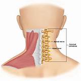 Images of Neck Surgery Pain
