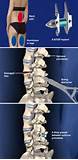 X Stop Spinal Decompression Photos