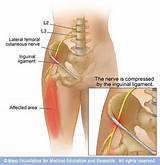 Lateral Femoral Cutaneous Nerve Entrapment Video Pictures