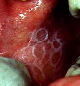 Is Lichen Planus An Autoimmune Disease Photos