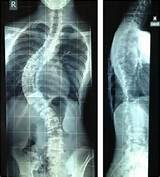 Pictures of Neurological Symptoms Scoliosis