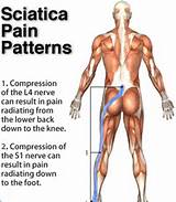 What Is Sciatic Nerve Damage Pictures