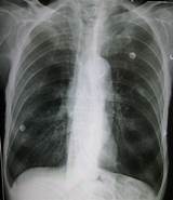Chronic Obstructive Pulmonary Disease X Ray Images
