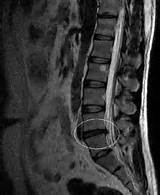 Pictures of Questions To Ask Doctor About Bulging Disc