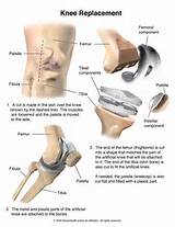 Diagnosis Code For Degenerative Joint Disease Hip Images