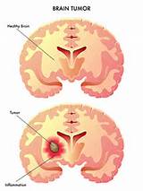 Pictures of Brain Malignant Tumor