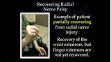 Pictures of Right Radial Nerve Palsy