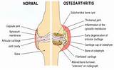 Osteo Arthritis Symptoms Pictures