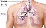 What Types Of Lung Cancer Are There Pictures