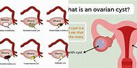 1 Cm Ovarian Cyst