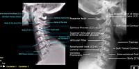 Lateral View of Cervical Spine Labeled