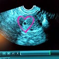 5 Week Gestational Sac Ultrasound