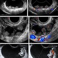 Abnormal Ovarian Cyst Ultrasound