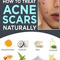 Acne Scars Home Remedy