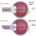 Anatomy of Eye Astigmatism