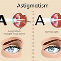 Astigmatism Double Vision