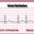 Atrial Fibrillation ECG Examples