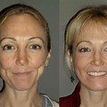 Bad Face Lifts Before and After