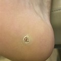 Black Seed Foot Wart