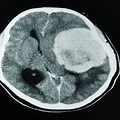 Black Spot On Brain CT Scan