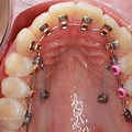 Braces Inside Teeth