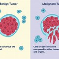 Brain Tumor Benign vs Malignant