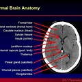 CT Scan Brain Axial View