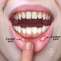 Canker Sore Inside Mouth