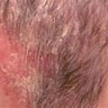 Eczema Hair Thinning Before and After