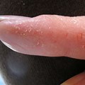 Eczema Rash On Fingers