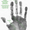 Fingerprinting and Dermatoglyphics