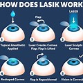 How Does Lasik Eye Surgery Work