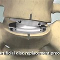 Lumbar Artificial Disc Replacement