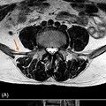 MRI of the Lumbar Spine Side View without Contrast