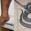 Male Snake Bites