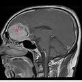 Meningioma IAC Base of Skull