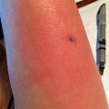 Mouse Bite On Arm