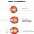 Myopia Eye Chart