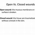 Open Vs. Closed Wound