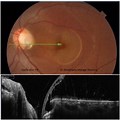 Optic Disc Pit Maculopathy Oct