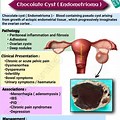 Ovarian Chocolate Cyst CT